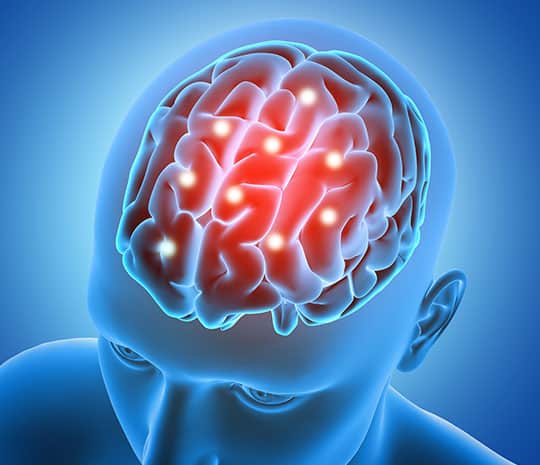 Fotografía de una exploración cerebral relacionada con una demanda por lesión cerebral traumática.