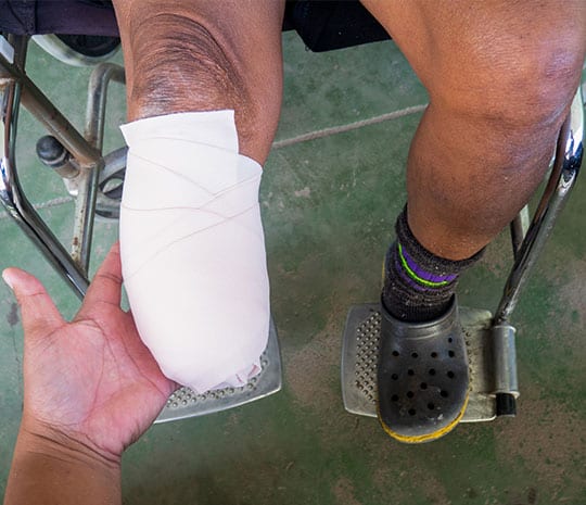 Fotografía de una persona en silla de ruedas con una pierna amputada, relacionada con una demanda por lesiones catastróficas.