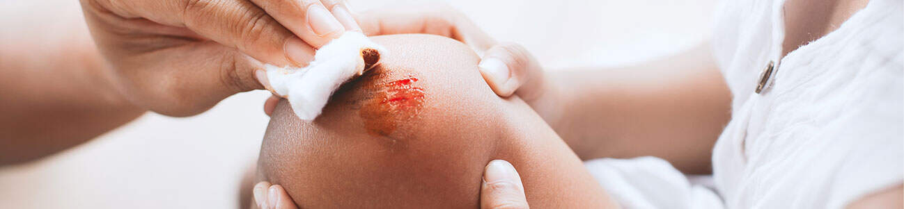 Oklahoma burn injury lawsuits.
