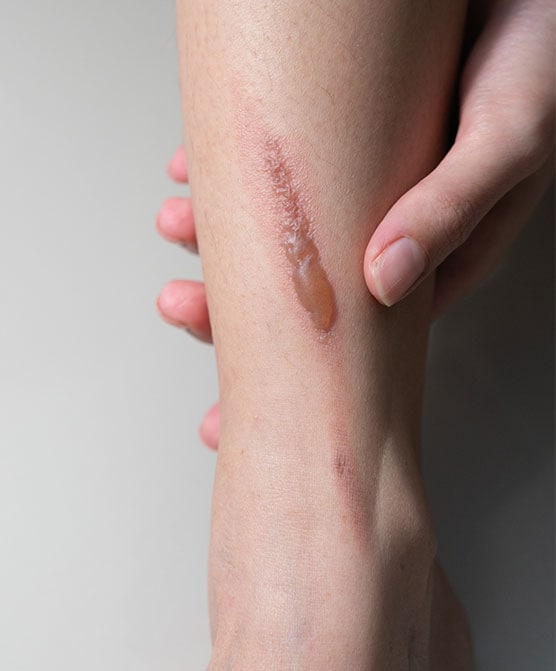Long-term effects of burn injuries.