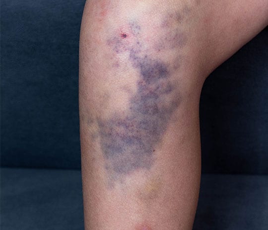Can Xeljanz cause blood clots?